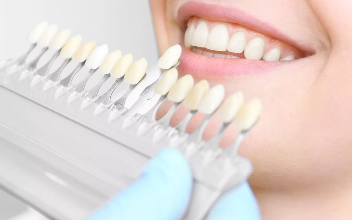 Что вы должны знать об отбеливании зубов
